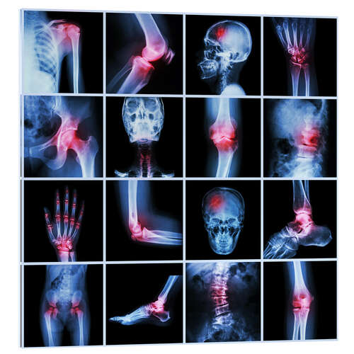 Quadro em acrílico Human joint, arthritis and stroke